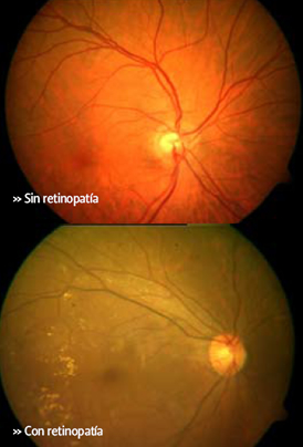 Retinopatía diabética