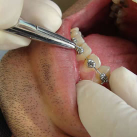 Microorganismos orales, su relación con la ortodoncia